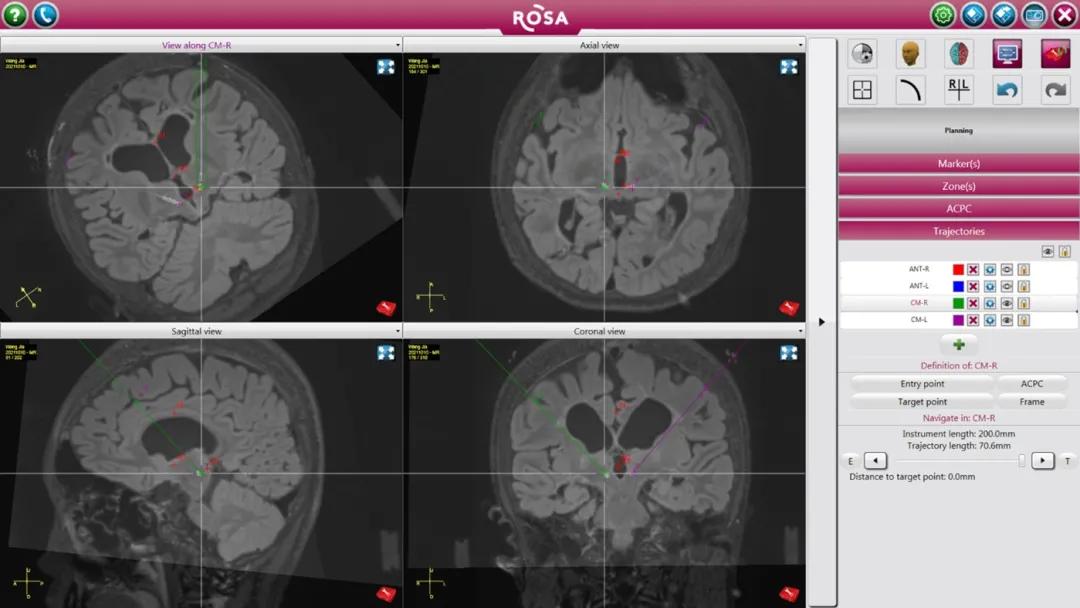 治疗癫痫的新希望,癫痫病人能做慢性小脑电刺激术吗