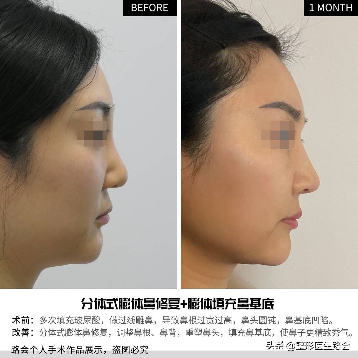 玻尿酸隆鼻立竿见影吗,玻尿酸隆鼻适合哪些鼻型