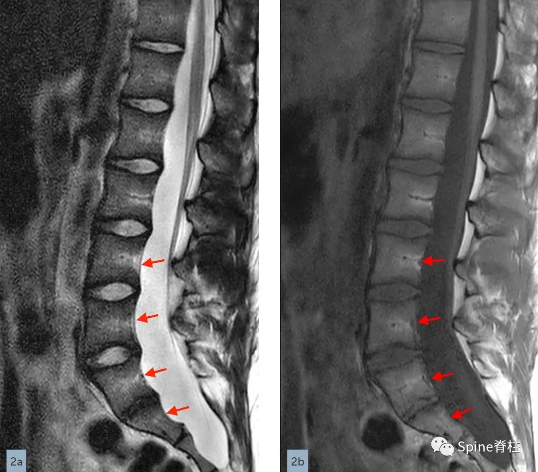 硬膜扩张,duralectasia