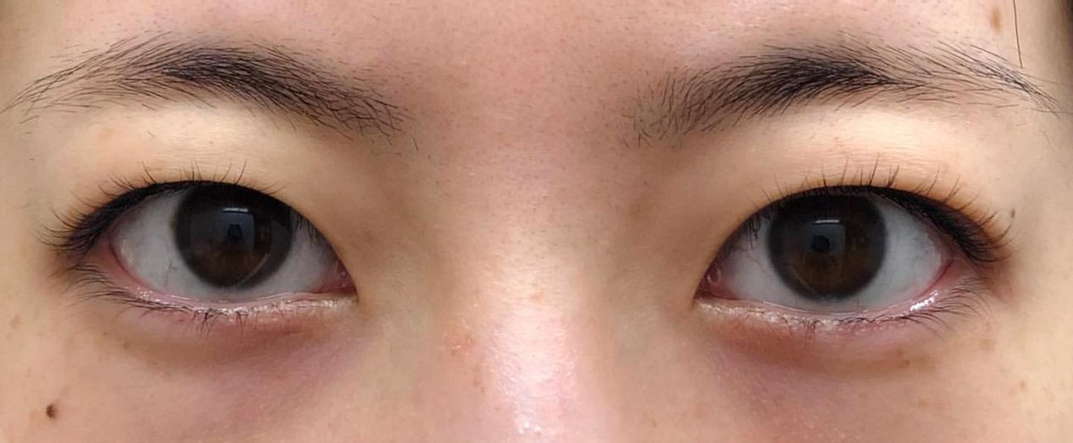 单眼皮肿眼泡去脂肪后适合埋线吗,单眼皮肿眼泡可以割薄一点吗