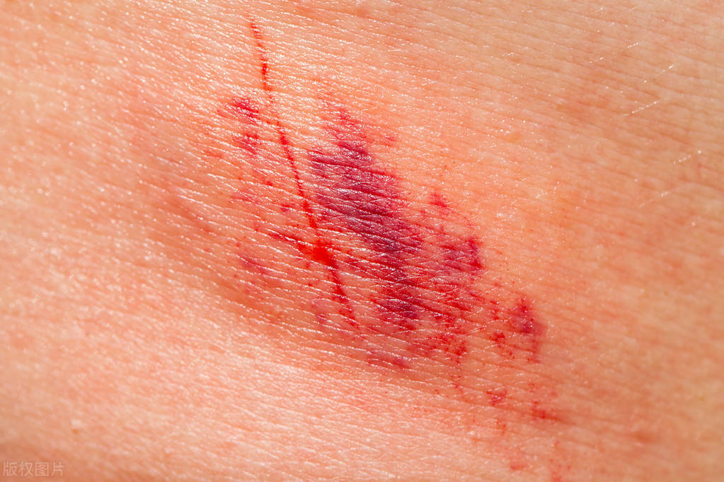 毛囊炎皮肤病是怎么引起的,皮肤病真菌毛囊炎症状