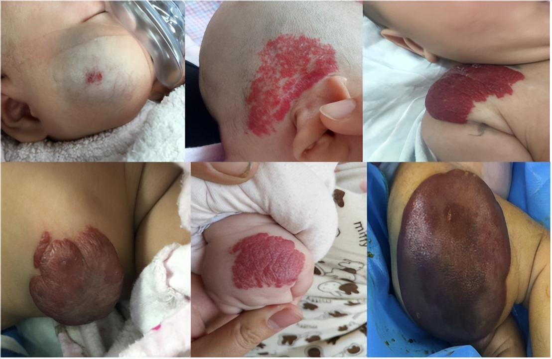 蔓状血管瘤是瘤还是血管畸形,宝宝血管瘤和血管畸形有什么区别