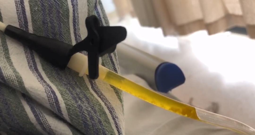 自闭症儿童粪菌移植最新进展,粪菌移植的自闭症女孩