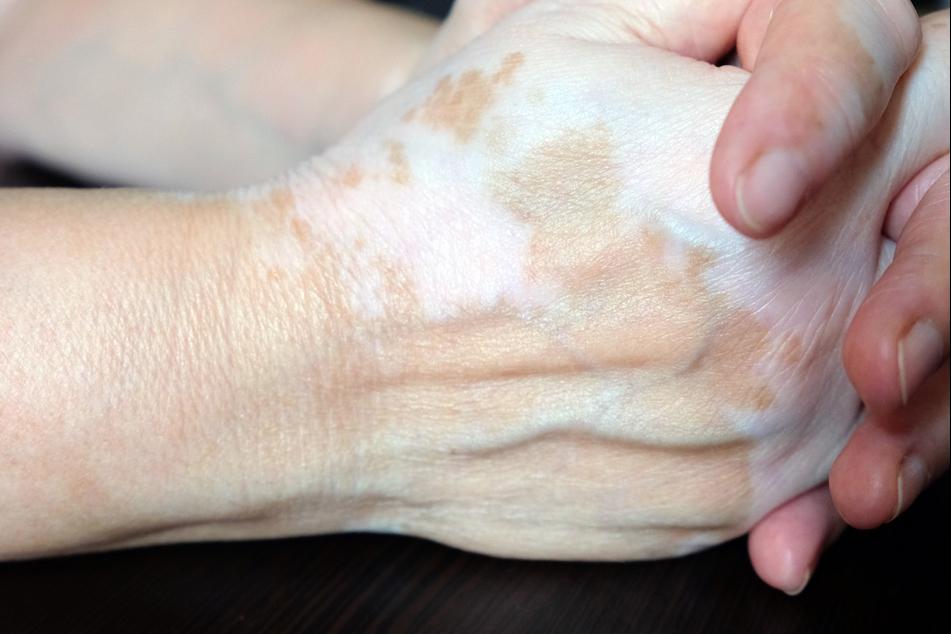 稳定期的白斑怎样快速复色,白斑复色成功