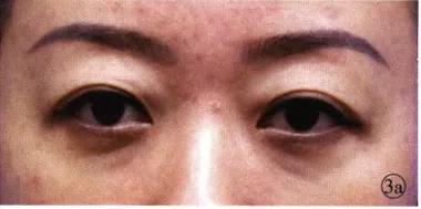 最快的方法帮你淡化泪沟,只需知道一招轻松消除显老泪沟