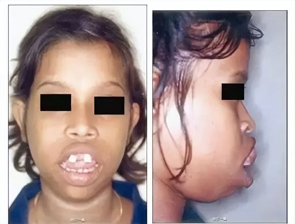 腺样体肥大的孩子手术怎么做,除了手术怎么改善孩子腺样体肥大