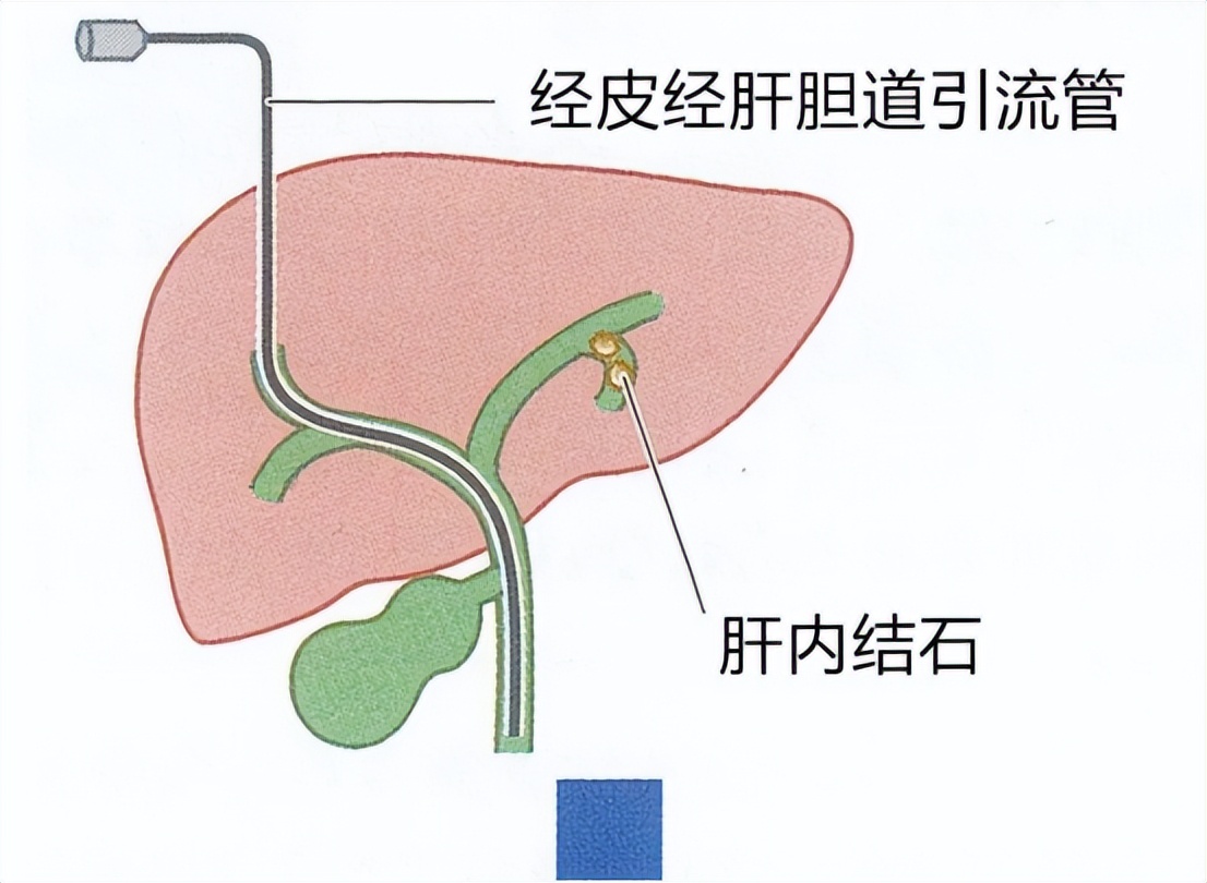 急性胆囊炎的主要治疗方法有哪些,急性胆囊炎最佳的治疗方案是什么