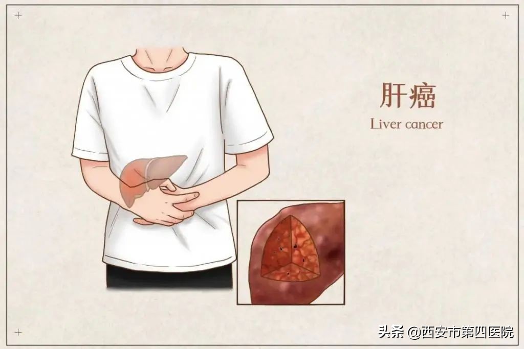 健康科普预防癌症,如何有效的预防癌症遗传