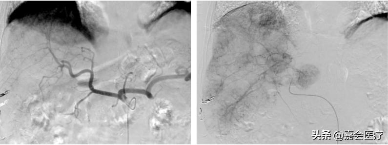 肝癌持续动脉灌注化疗注意事项,肝癌经肝动脉栓塞化疗