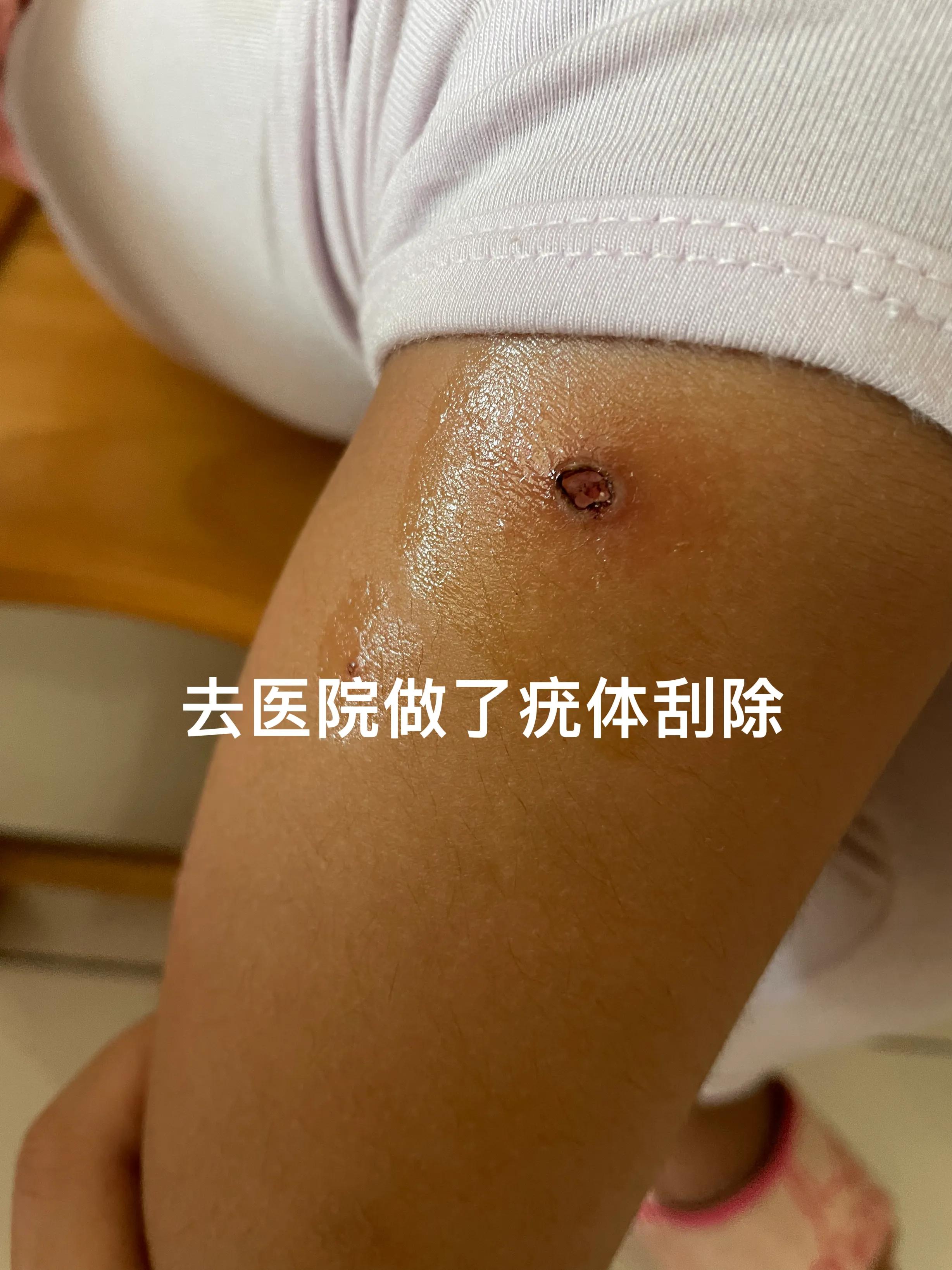 包皮传染性软疣自愈,传染性软疣多久可以自愈