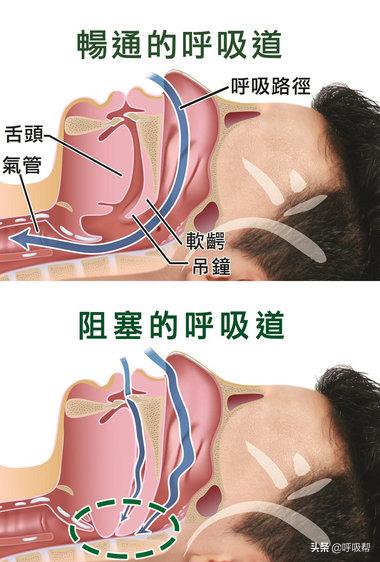 如何测出呼吸机平台压,鱼跃呼吸机如何调整压力