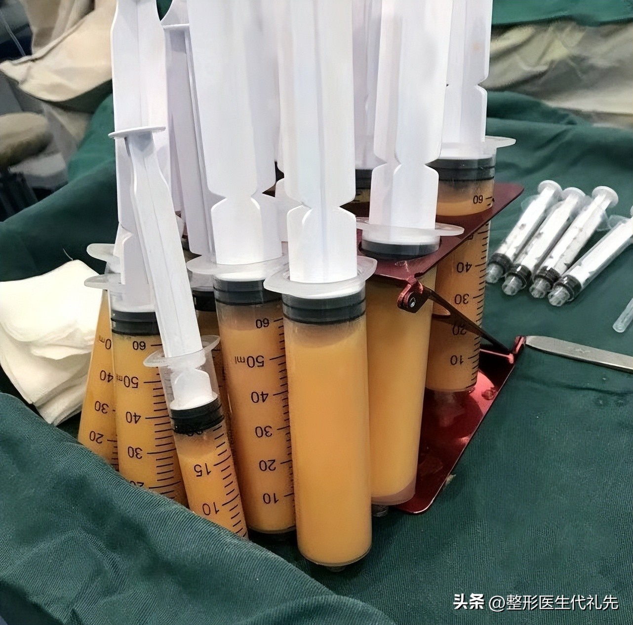 面部脂肪填充一般要多少脂肪量,脂肪填充面部有哪些脂肪可以做