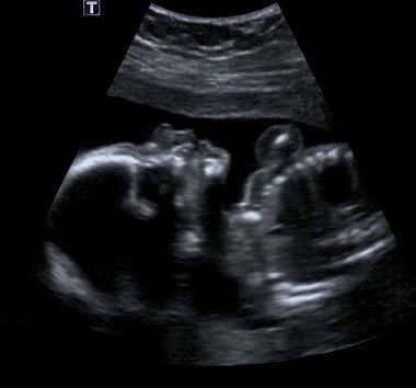 孕晚期胎宝宝一抖一抖,胎宝宝在肚子里一抖一抖是打嗝吗