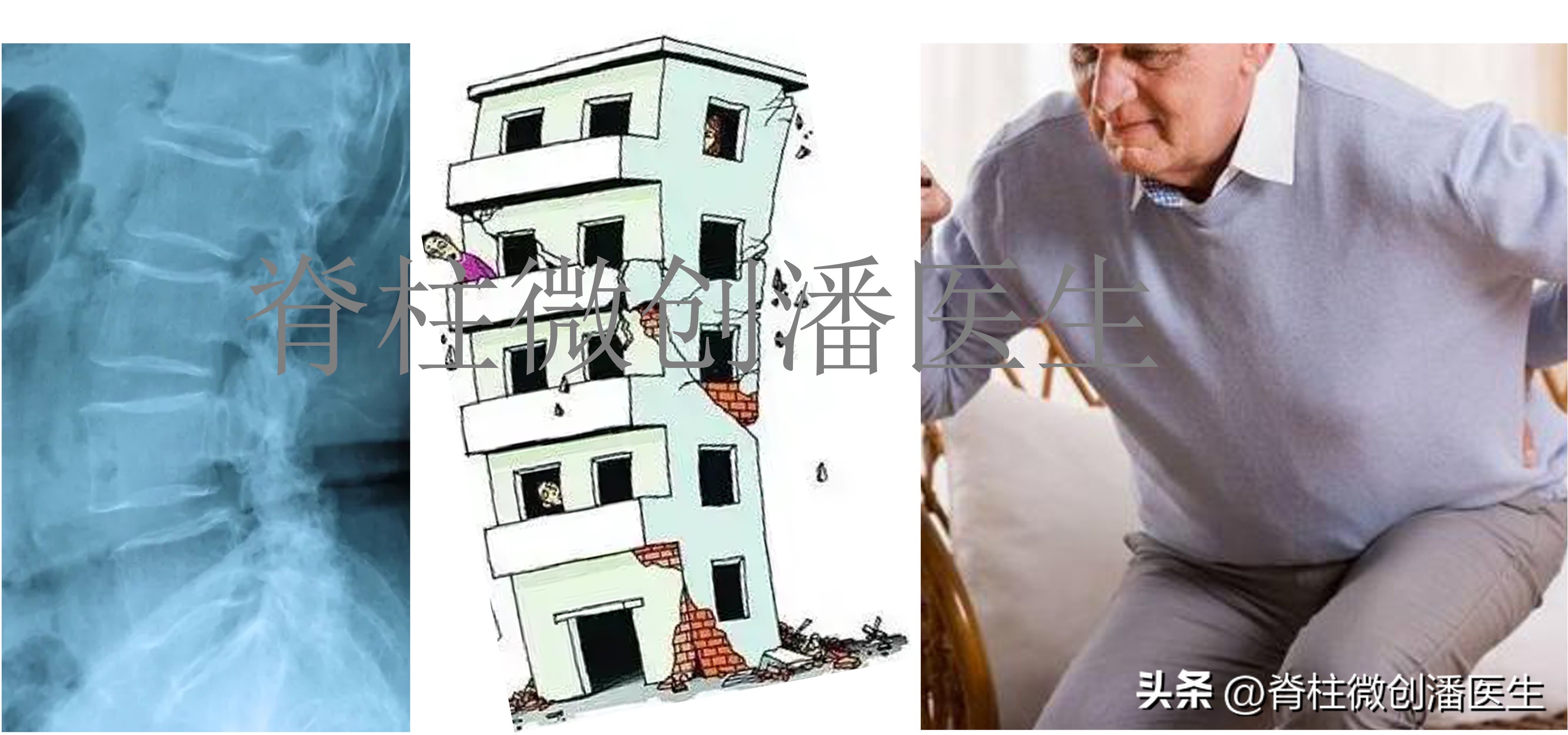 年龄增长引起的腰椎退变性滑脱