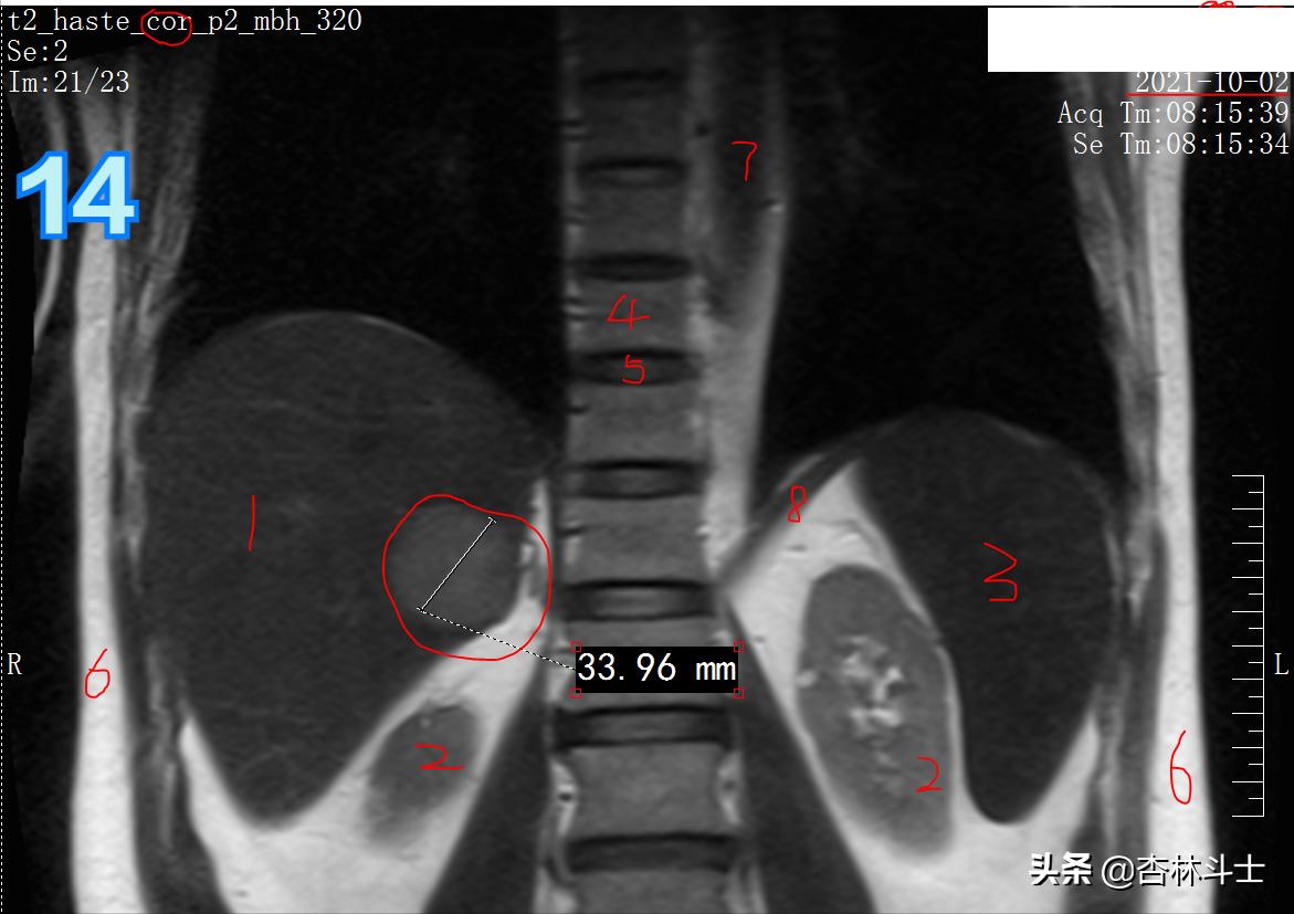 肝癌8公分肿瘤能活多久,肝癌细胞最大长多大
