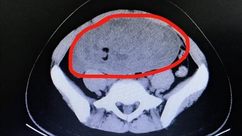 有癌腰痛是什么症状,体内有癌腰部先知