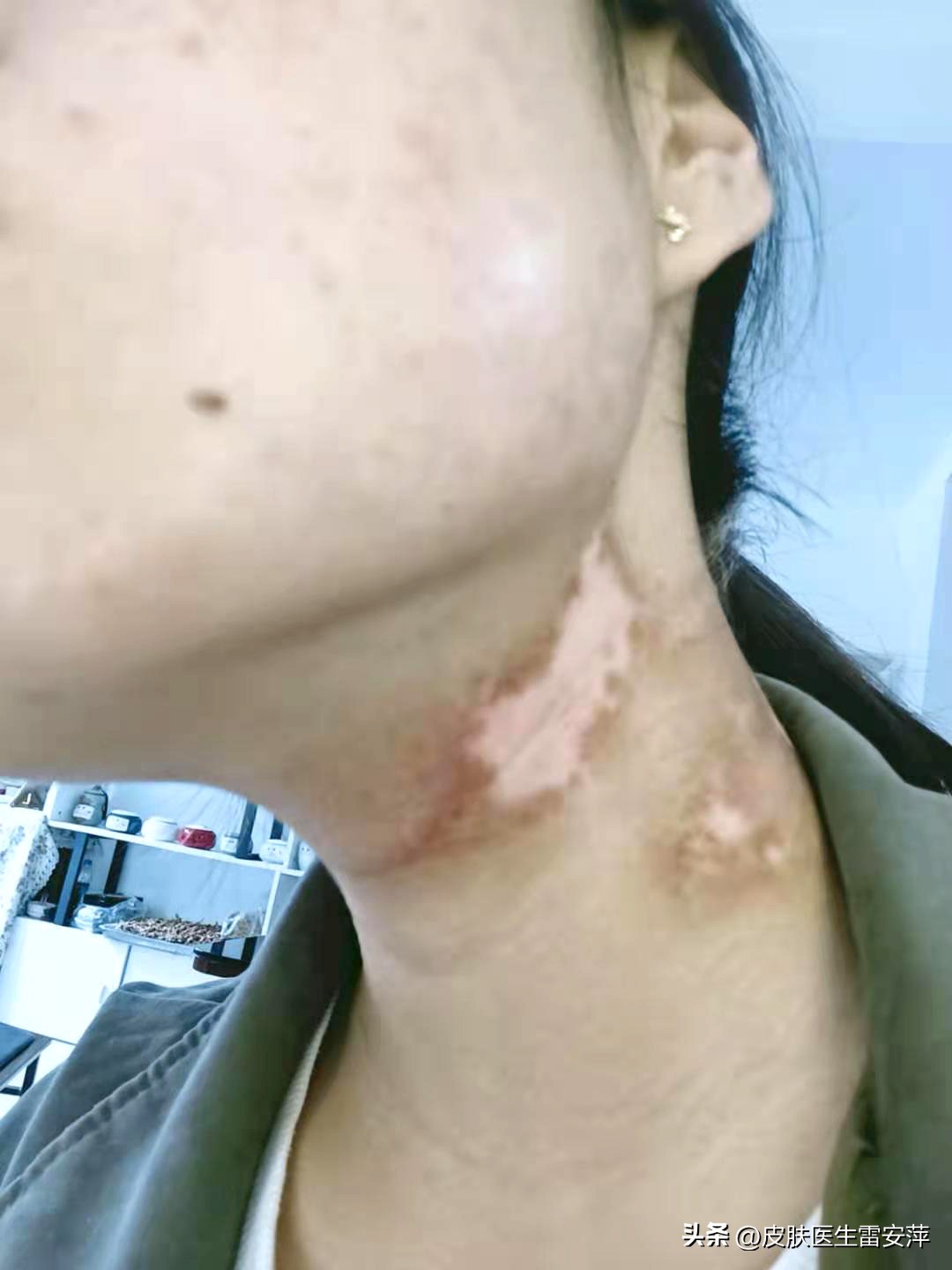 茄子治疗白癜风治好的几率是多少,儿童白癜风治好的几率有多大