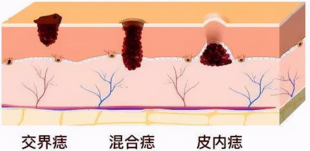 一旦身上出现这2种痣，多半是被癌盯上了！其中一种是肝癌的信号，别因为不痛不痒忽略了