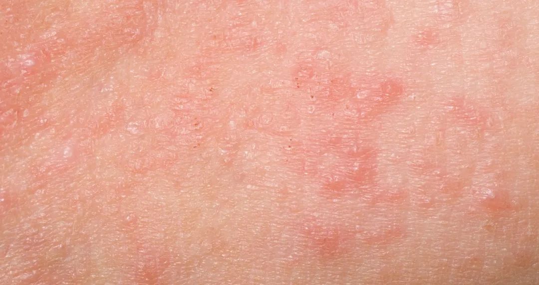 孩子过敏鼻炎湿疹怎么办,过敏湿疹的症状和表现