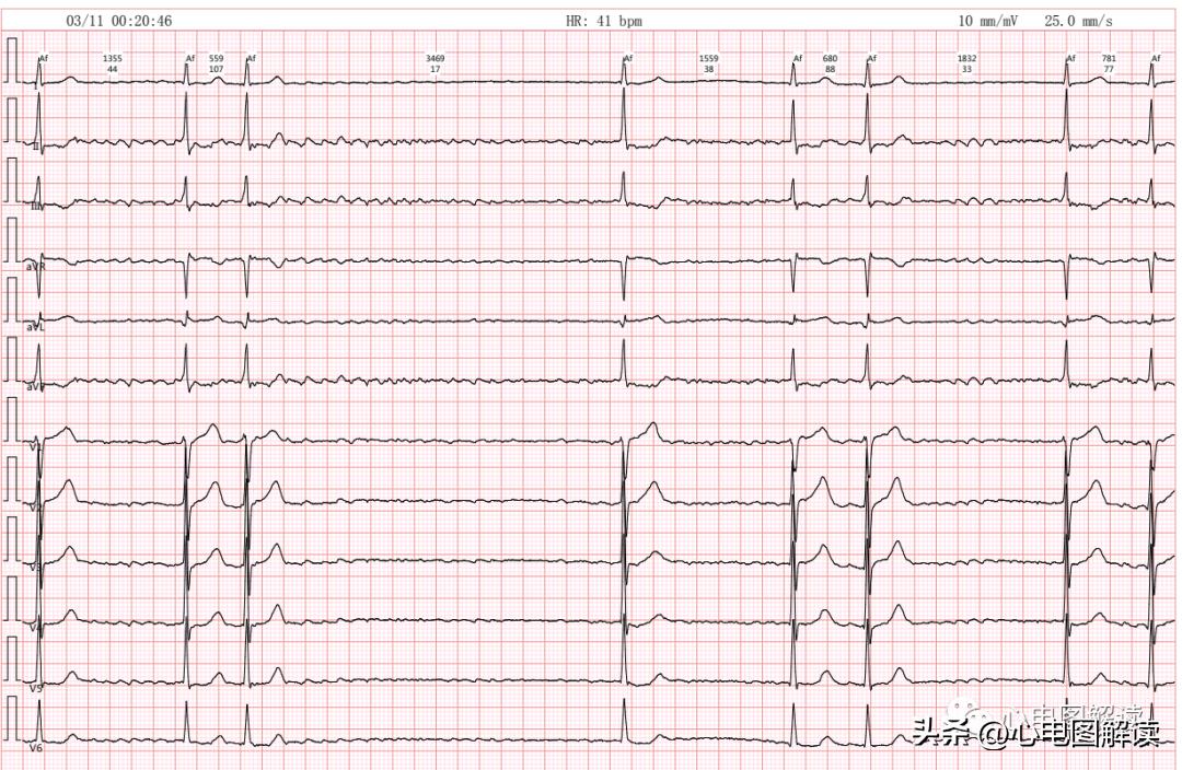 心房颤动伴长间歇能做射频消融吗,心房颤动伴停搏严重么