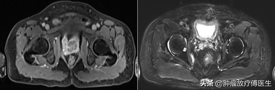 前列腺癌三维适形放疗,前列腺癌放射治疗策略与进展