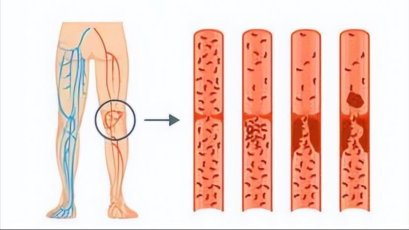 医者仁心|小滤器大作用！撑起生命的保护伞