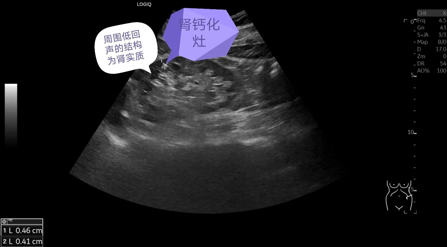 解读肾脏超声检查报告:肾结石、肾结晶、肾钙化灶到底什么关系?
