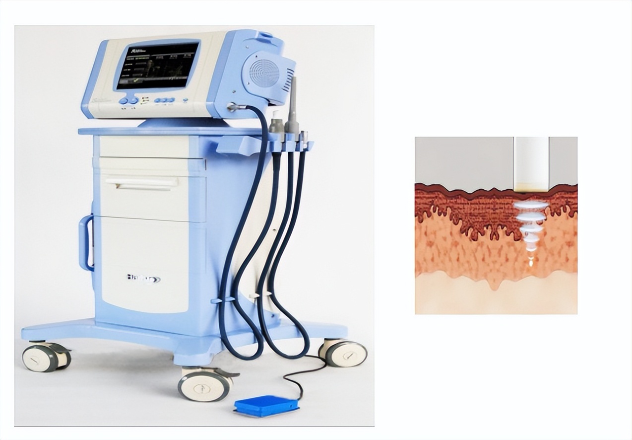 不开刀介入治疗,宫颈超声聚焦治疗后会出血吗