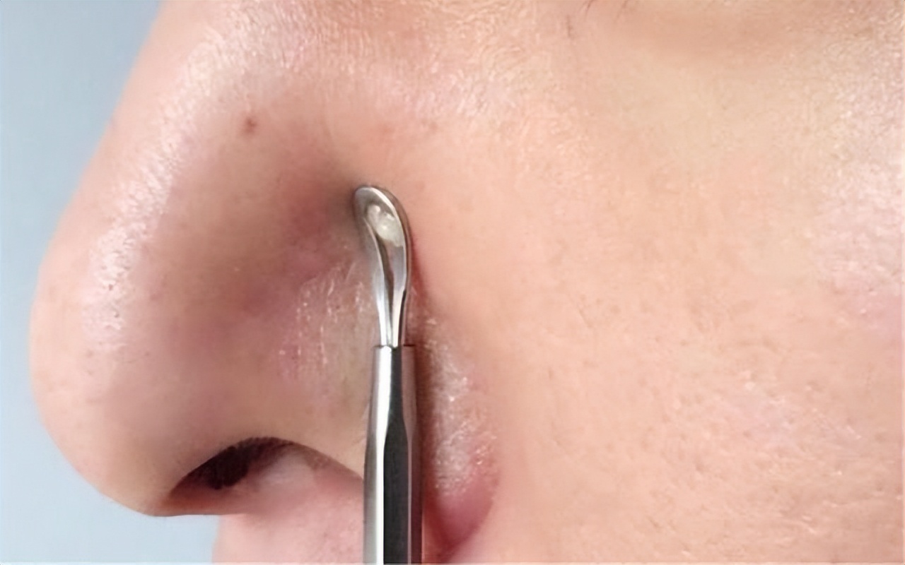 鼻子两侧的螨虫可以挤吗,鼻子里挤出的白色细条是螨虫吗