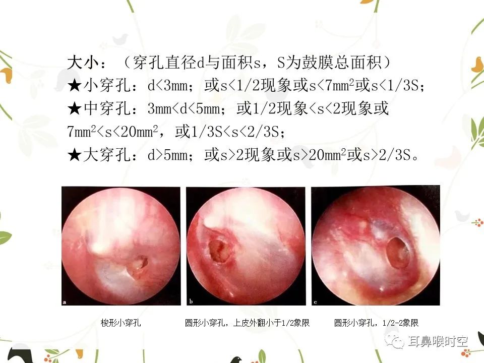 鼓膜可见穿孔,鼓膜穿孔听力下降能恢复吗