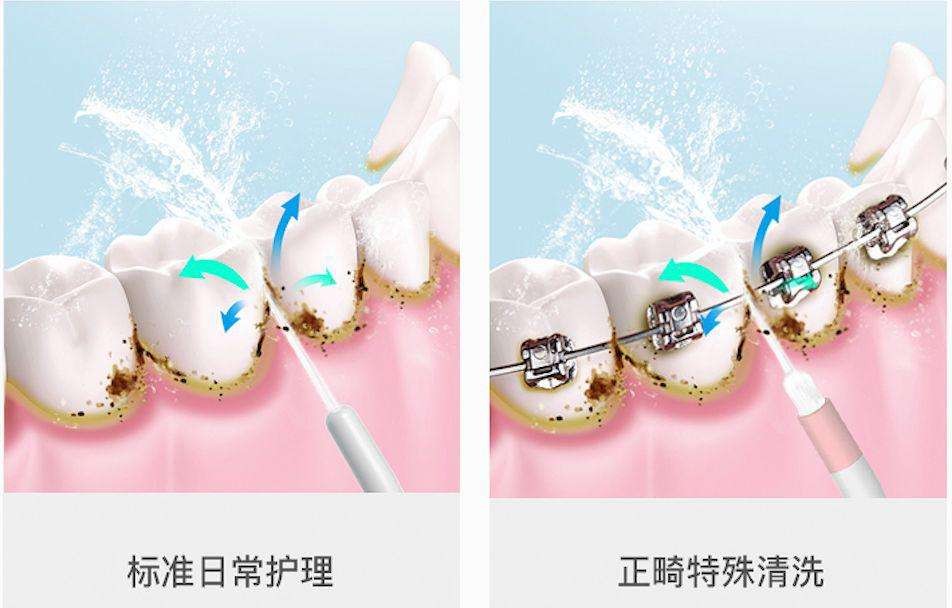 冲牙器的作用和危害,冲牙器有什么危害和副作用