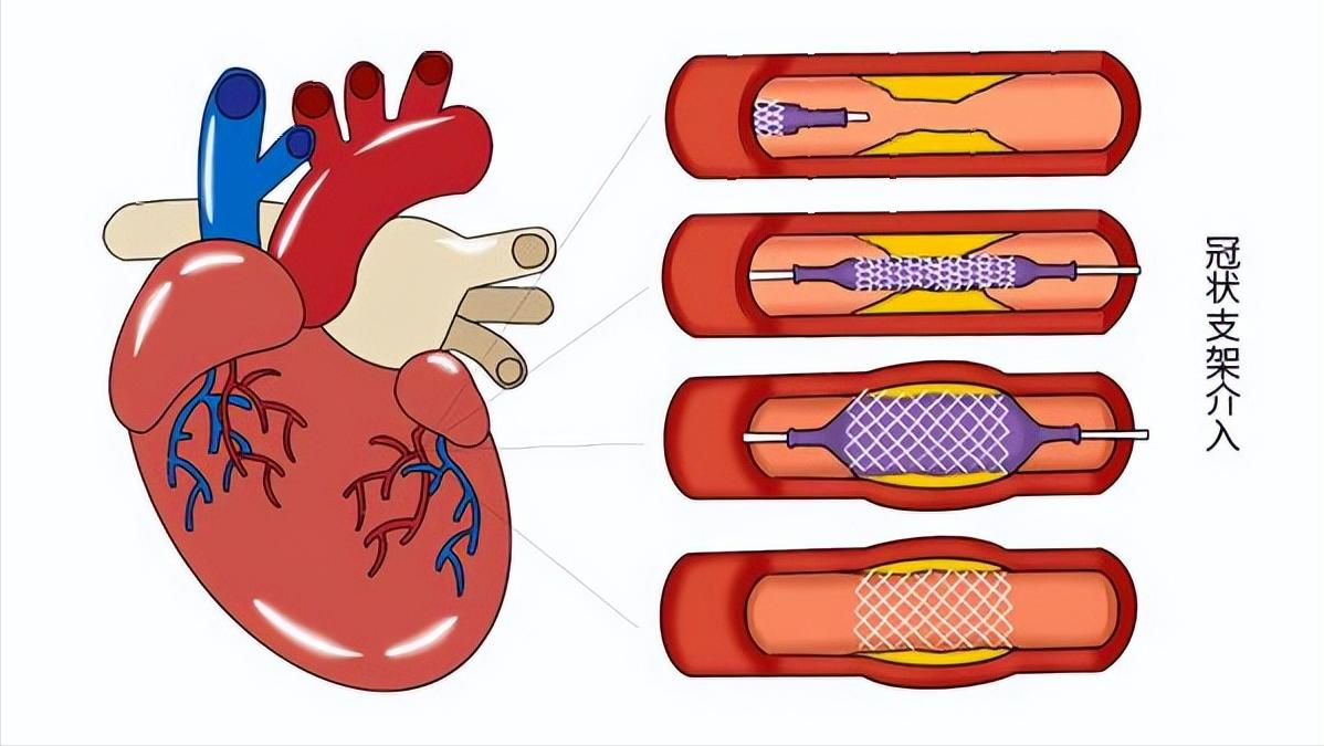心脏支架手术做了还会堵,还有必要做吗?做与不做取决于这一点