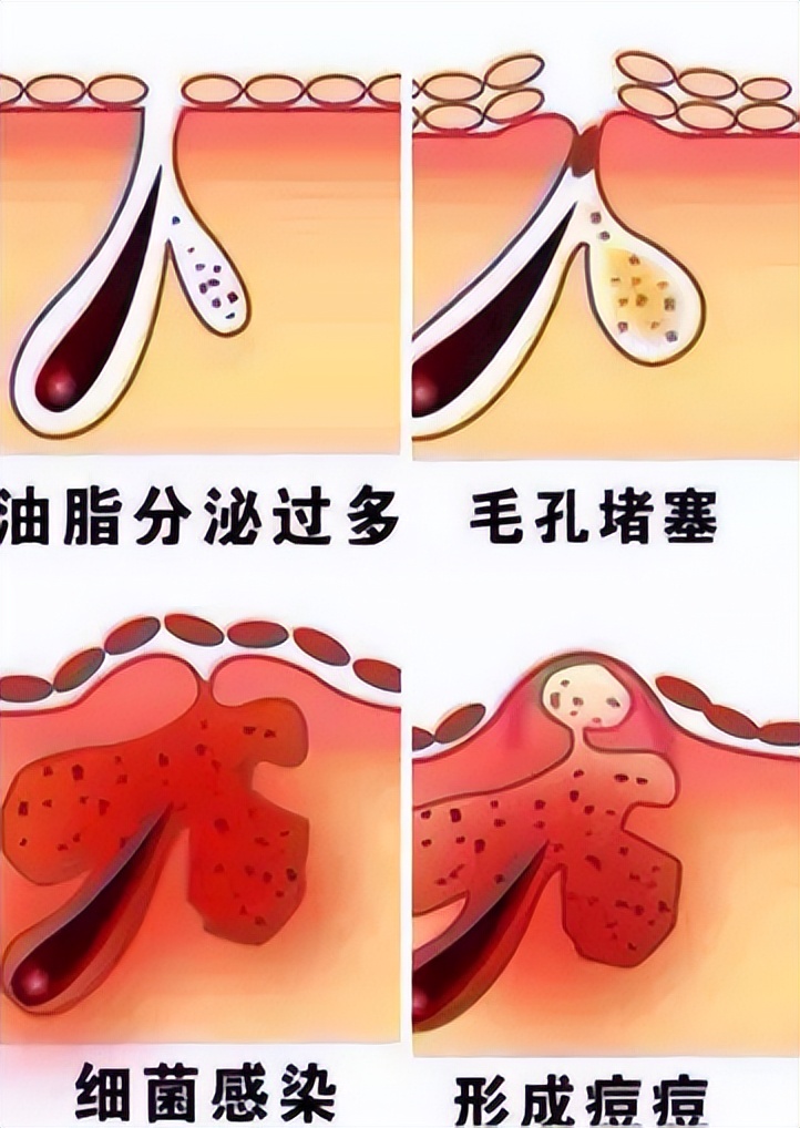 青春痘太多想消除,青春期长痘后毛孔变大怎么修复