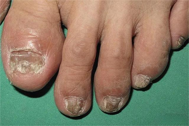 甲癣不严重怎么治疗,甲易生治疗灰指甲吗