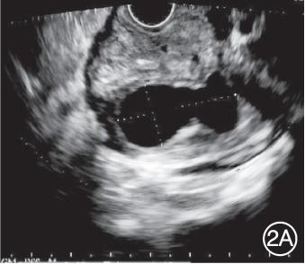 超声内镜诊治合并假性囊肿的沟槽状胰腺炎1例
