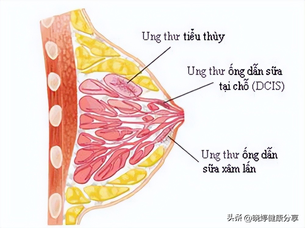 乳腺癌患者需要知道的病情知识,女性朋友必知四种乳腺癌筛查方式
