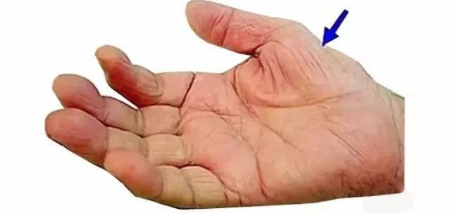 鼠标手腕管综合征挂什么科,白领鼠标手腕管综合征