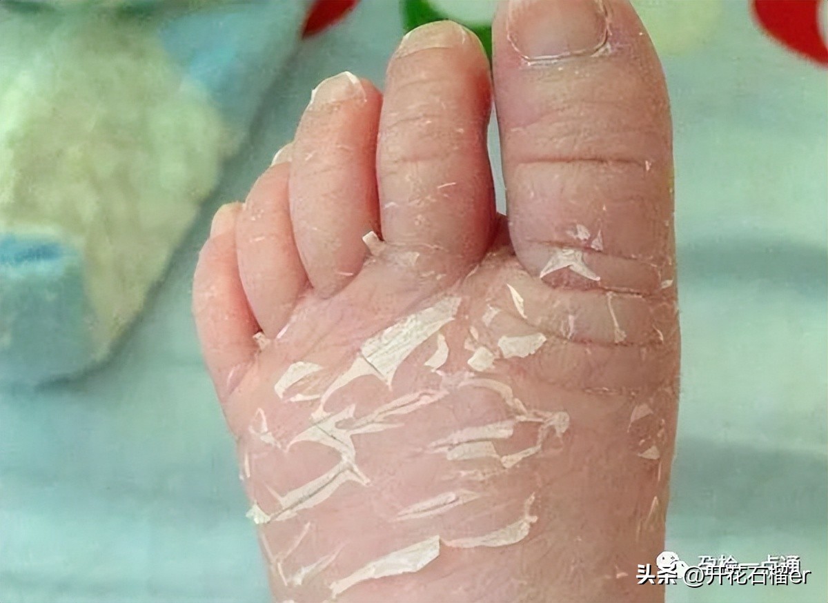 新生儿这5大状况你最担心哪个,新生儿有些表现不用治您知道吗