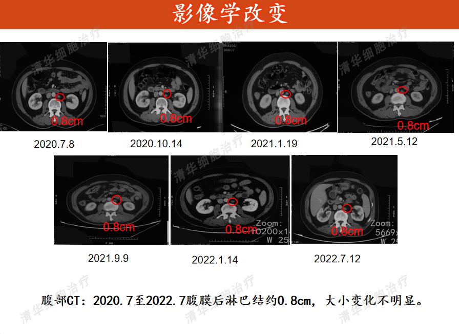 膀胱癌，两年内3次手术2次化疗，怎样才能彻底解决问题