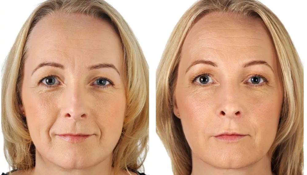 有法令纹与没有法令纹的区别,有法令纹和没法令纹的差别图片