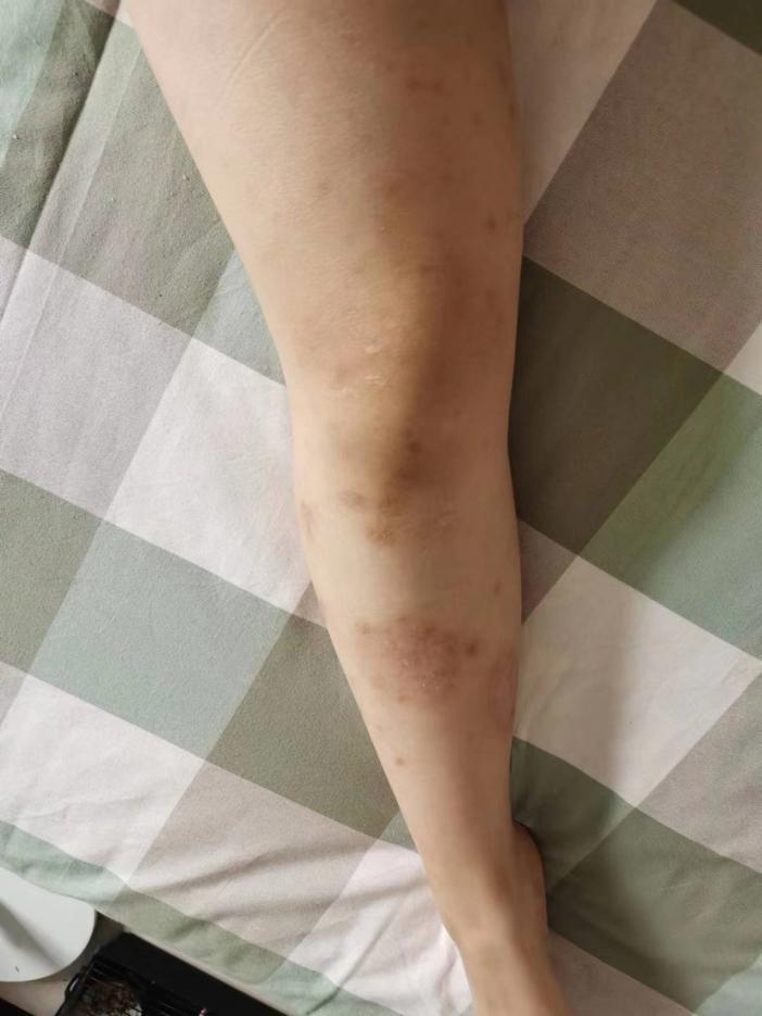 【门诊医讯】河北省人民医院皮肤科专病门诊——银屑病门诊