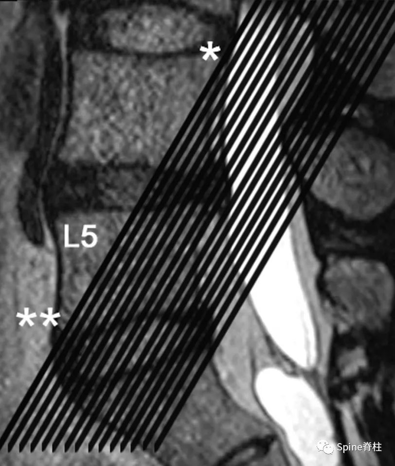腰椎间盘突出下肢放射痛严重吗,下肢放射疼痛是间断性严重吗