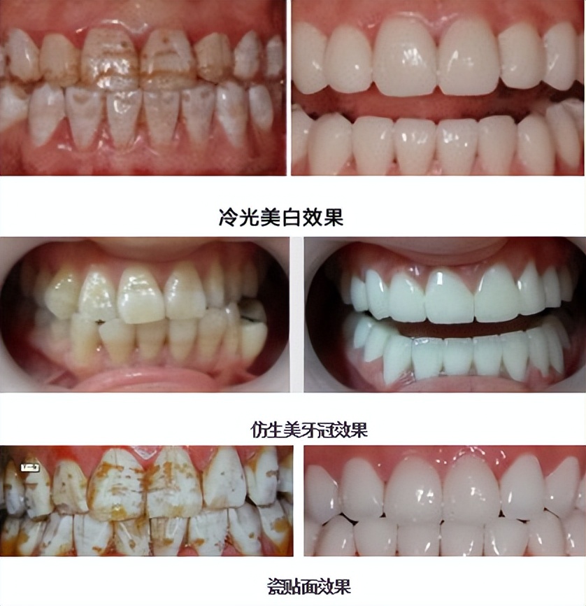 一分钟治愈牙齿黄斑,牙齿有病变怎么办