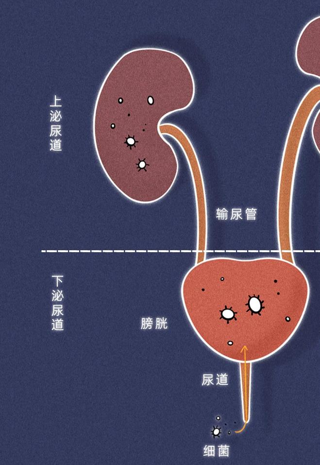 3个方面症状提醒你注意尿路感染,发生院内尿路感染最常见原因