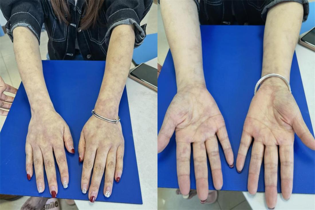 腿上起了湿疹又莫名的发青,女30岁腿脚老是肿怎么回事