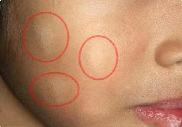 小孩子脸上长白斑需要吃打虫药吗,孩子脸上长斑是该打虫子了吗
