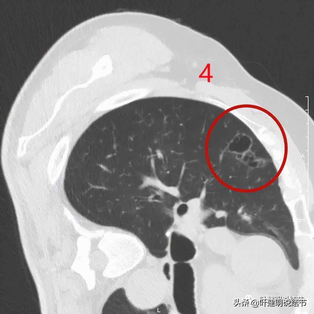 肺多发结节切除一个剩下的怎么办,无限纠结的肺小结节