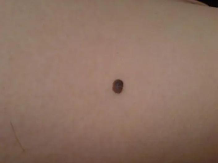 身体5个地方长“黑痣”，或许是肠息肉的“暗示”，要引起警惕