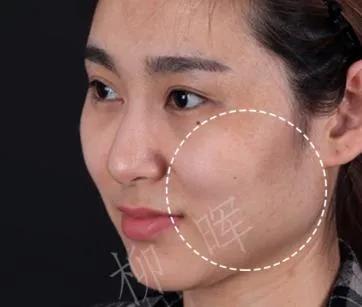 面颊凹陷适合打哪个玻尿酸,脸颊凹陷不饱满