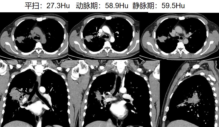 机化性肺炎用药多久复查ct,坠积性肺炎ct表现